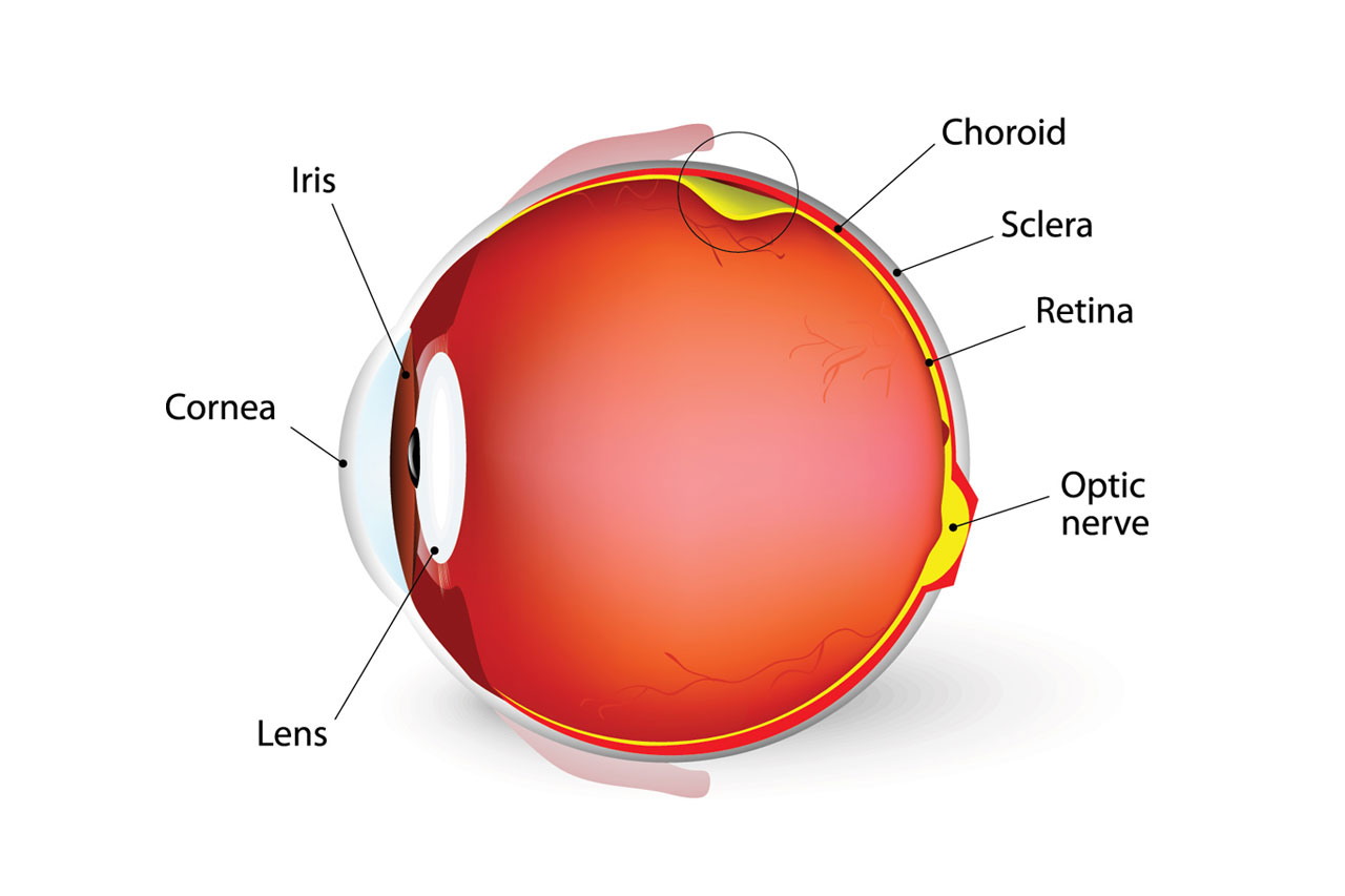 ¿Qué es la Retinopatía Diabética y cuál es la Importancia de prevenirla?