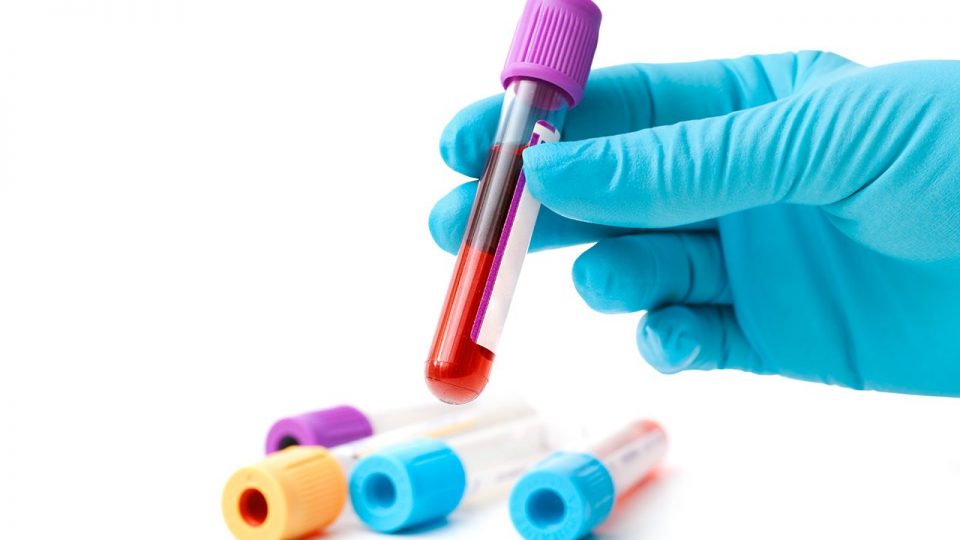 ¿Qué significa Hemoglobina Glicosilada o A1c?