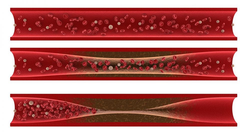¿Qué es y cómo se origina la Ateroesclerosis?